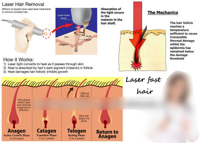 Is Laser Hair Removal Not Working? Here are Some Reasons Why - Este
